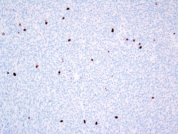 10E Liponeurocytoma, cerebellar (Case 10) 5MIB1 1.jpg