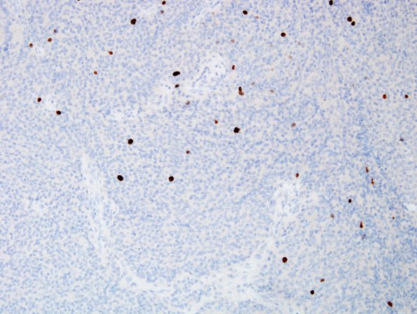 10E Liponeurocytoma, cerebellar (Case 10) Ki671.jpg