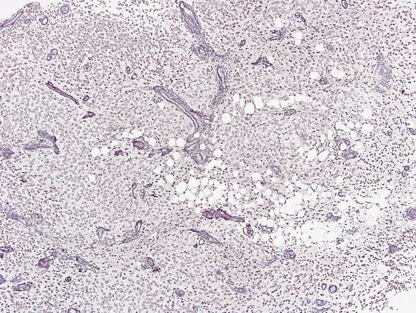 10F Liponeurocytoma, cerebellar (Case 10) Retic 1.jpg