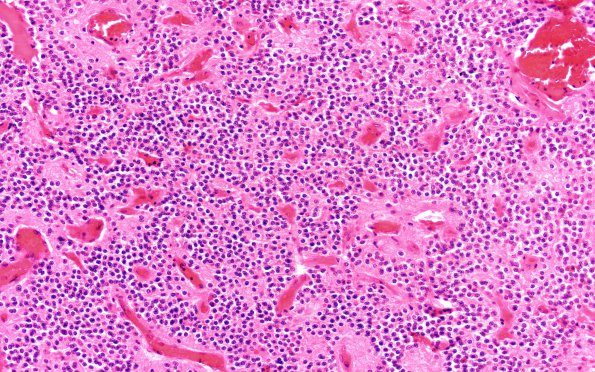 11A1 Central Neurocytoma (Case 11) 20X