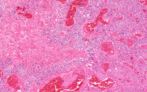 11A2 Central Neurocytoma (Case 11) 10X