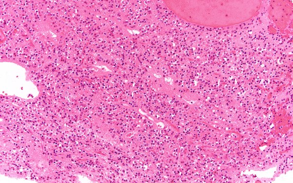 12A Neurocytoma, central (Case 12) H&E 20X