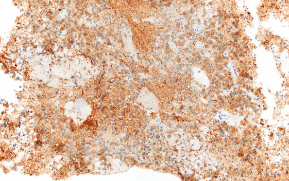 12B1 Neurocytoma, central (Case 12) SYN 20X 2