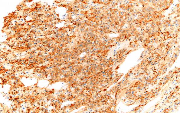 12B2 Neurocytoma, central (Case 12) SYN 20X