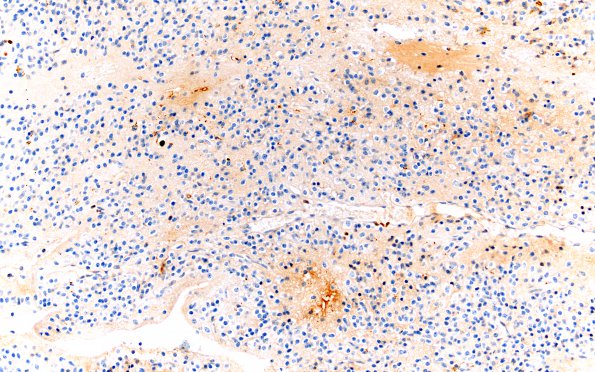 12C Neurocytoma, central (Case 12) Ki67 20X