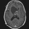 12D1 Neurocytoma, central (Case 12) T1 W 1 repeat - Copy