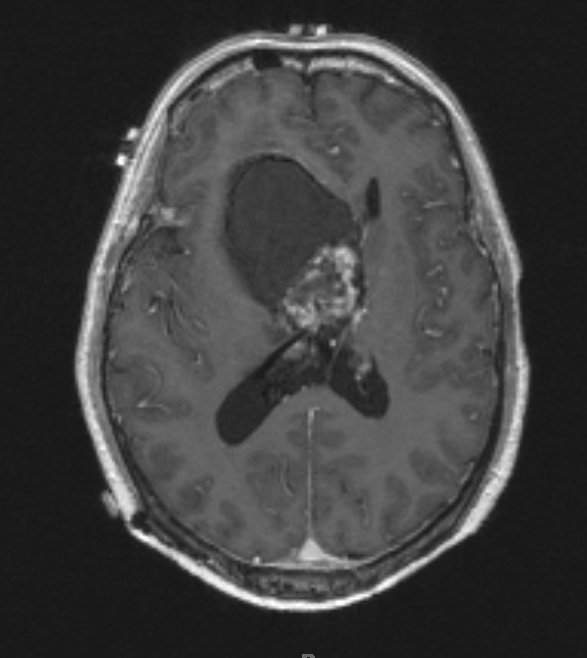 12D1 Neurocytoma, central (Case 12) T1 W 1 repeat - Copy