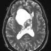 12D2 Neurocytoma, central (Case 12) T2 W 1 - Copy