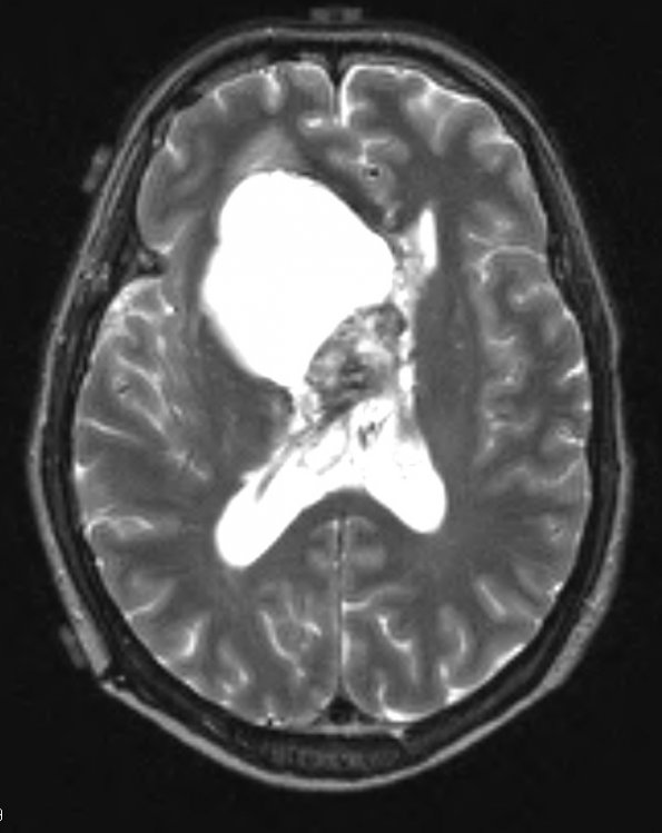 12D2 Neurocytoma, central (Case 12) T2 W 1 - Copy