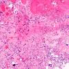 12E Neurocytoma, central (Case 12) H&E 4X