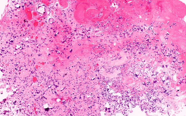 12E Neurocytoma, central (Case 12) H&E 4X