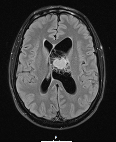 13A1 Central neurocytoma (Case 13) FLAIR NoC