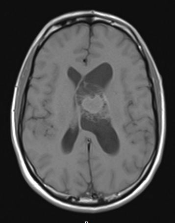 13A2 Central neurocytoma (Case 13) T1 NoC