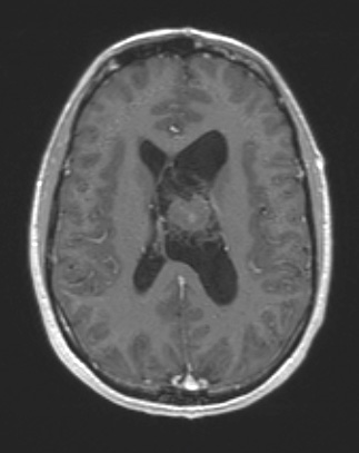 13A3 Central neurocytoma (Case 13) T1 W