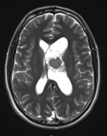 13A4 Central neurocytoma (Case 13) T2 NoC