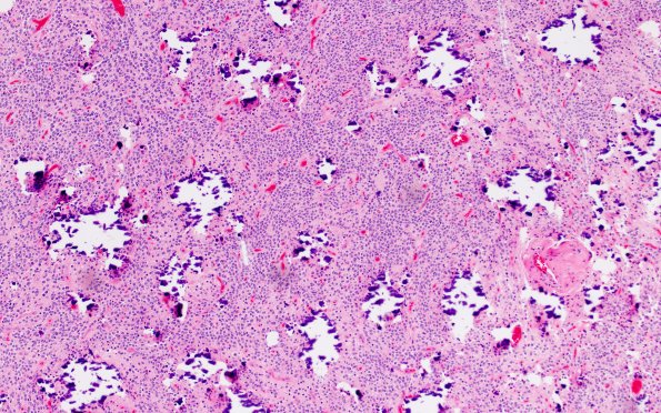 13B1 Central neurocytoma (Case 13) H&E 10X
