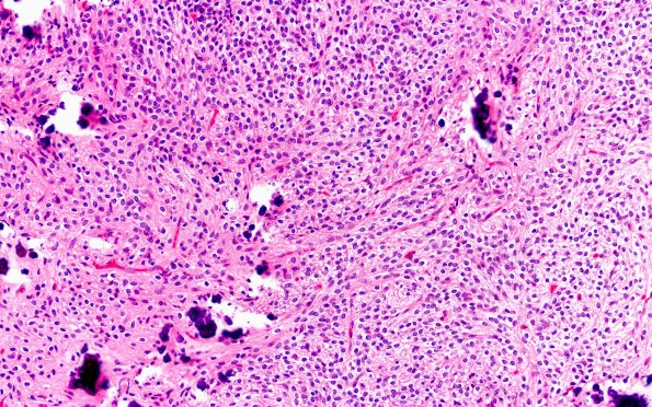 13B2 Central neurocytoma (Case 13) H&E 20X