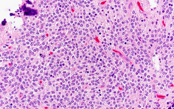 13B3 Central neurocytoma (Case 13) H&E 40X