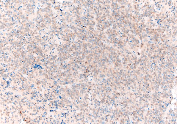 13D Central neurocytoma (Case 13) Neu-N 20X