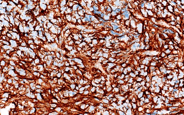 13E2 Central neurocytoma (Case 13) GFAP 40X 1