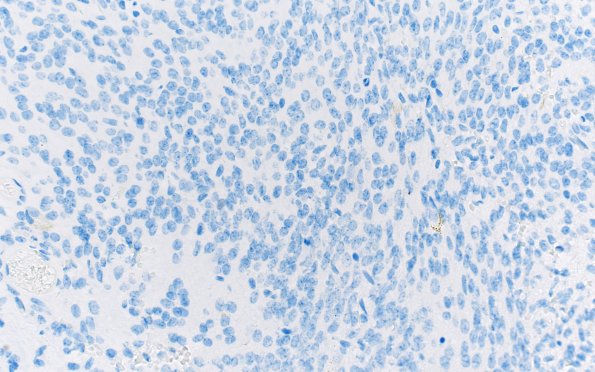 13F Central neurocytoma (Case 13) Olig2 40X 2