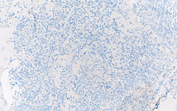 13G Central neurocytoma (Case 13) IDH1 20X