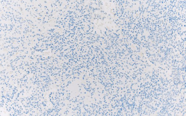 13H Central neurocytoma (Case 13) p53 20X