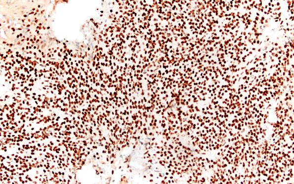 13I Central neurocytoma (Case 13) ATRX 20X 1