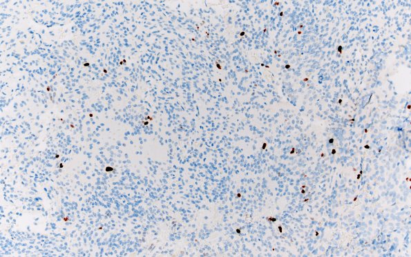 13J Central neurocytoma (Case 13) Ki67 20X