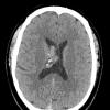 1A1 Central Neurocytoma (Case 1) CT 1