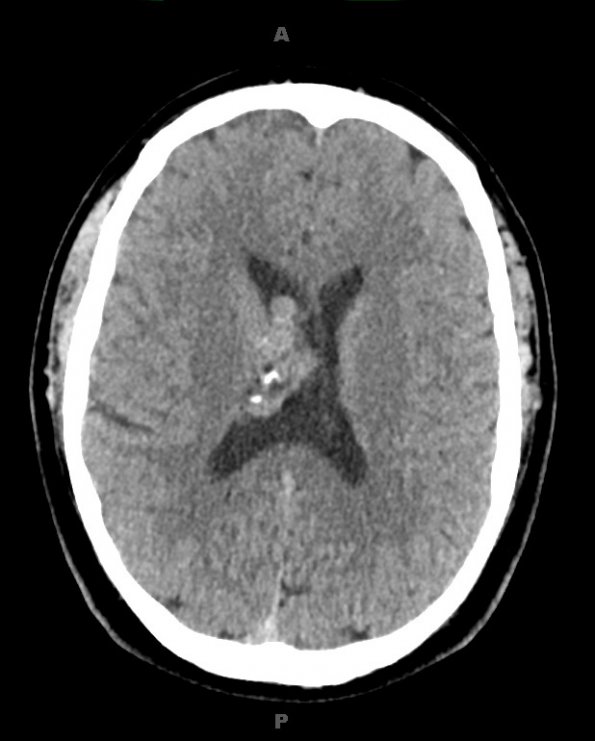 1A1 Central Neurocytoma (Case 1) CT 1