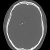 1A2 Central Neurocytoma (Case 1) Bone Window Calcifications copy