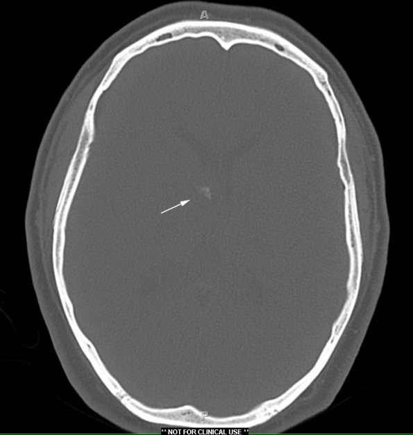 1A2 Central Neurocytoma (Case 1) Bone Window Calcifications copy