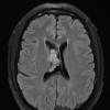 1A3 Central Neurocytoma (Case 1) TRA TIRM 1