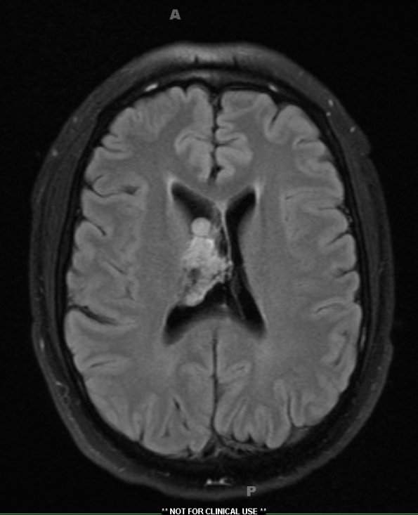 1A3 Central Neurocytoma (Case 1) TRA TIRM 1