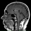 1A4 Central Neurocytoma (Case 1) T1 1