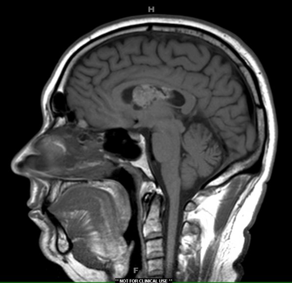 1A4 Central Neurocytoma (Case 1) T1 1