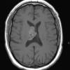 1A5 Central Neurocytoma (Case 1) T1 2