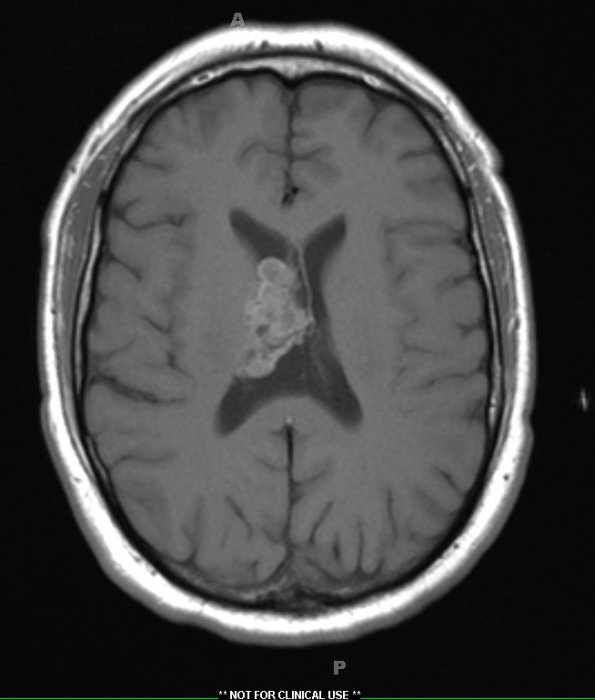 1A5 Central Neurocytoma (Case 1) T1 2