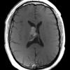 1A6 Central Neurocytoma (Case 1) T1W POST 1