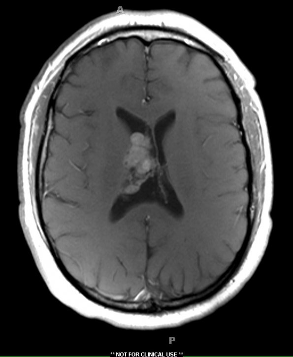 1A6 Central Neurocytoma (Case 1) T1W POST 1