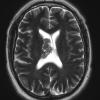 1A7 Central Neurocytoma (Case 1) T2 W 1