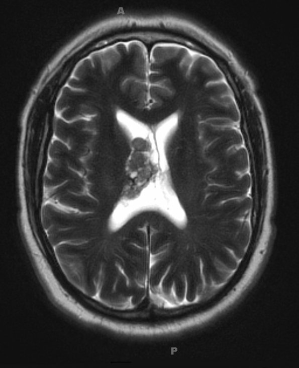 1A7 Central Neurocytoma (Case 1) T2 W 1