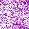 1B1 Central Neurocytoma (Case 1) H&E smear 2.jpg