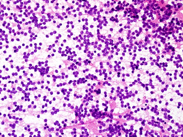 1B1 Central Neurocytoma (Case 1) H&E smear 2.jpg