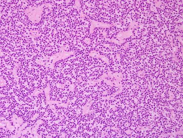 1B2 Central Neurocytoma (Case 1) H&E 9.jpg