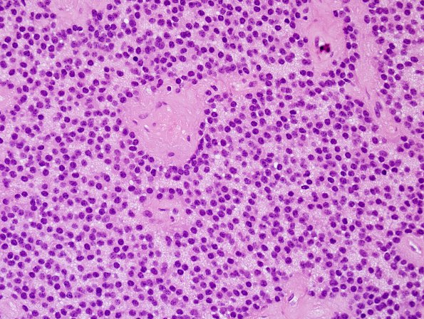 1B3 Central Neurocytoma (Case 1) H&E 10.jpg