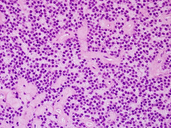 1B4 Central Neurocytoma (Case 1) H&E 1.jpg