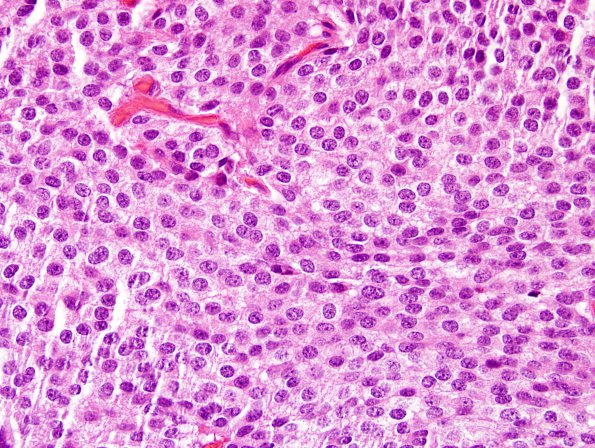 1B5 Central Neurocytoma (Case 1) H&E 7.jpg