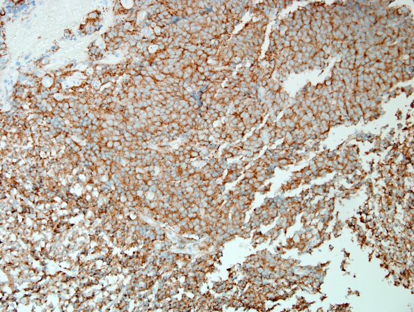 1C1 Central Neurocytoma (Case 1) SYN 4.jpg